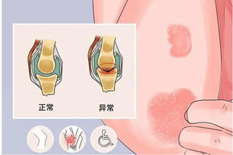 了解一下牛皮癣的传播方式!有哪几种途径?