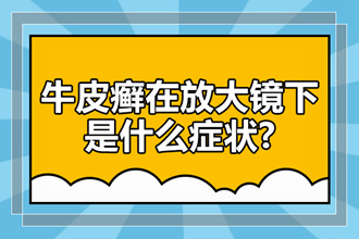 牛皮癣会引起的一些其他症状有哪些