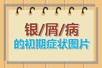 体癣和牛皮癣在身体上面有哪些不同